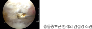 충돌증후군 환자의 관절경 소견