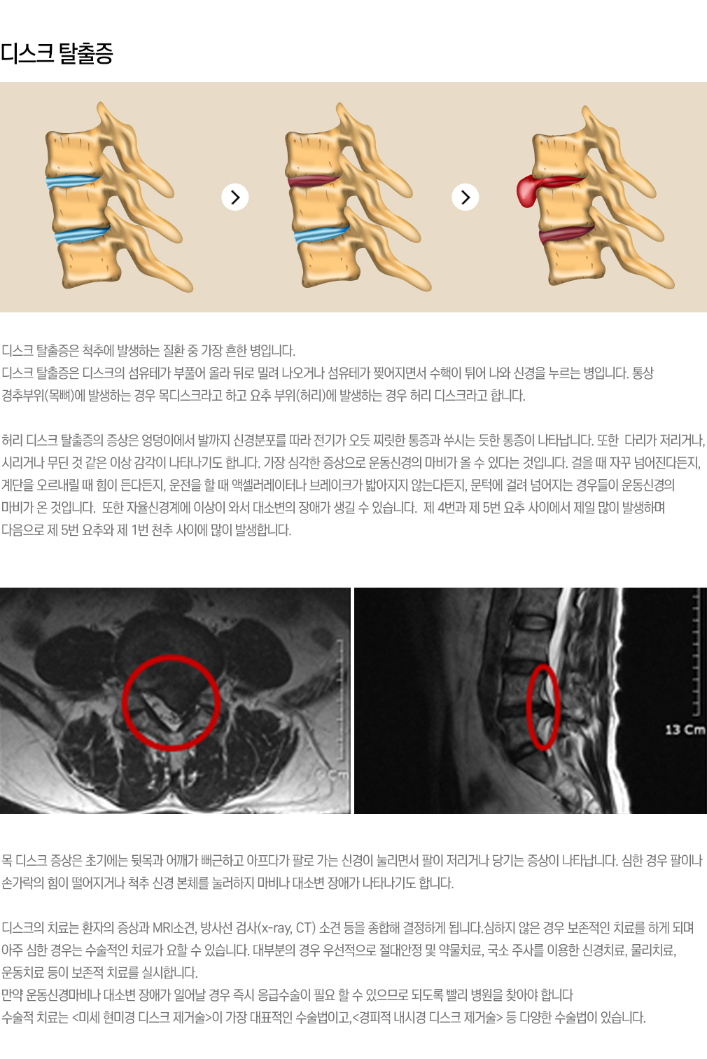 허리디스크