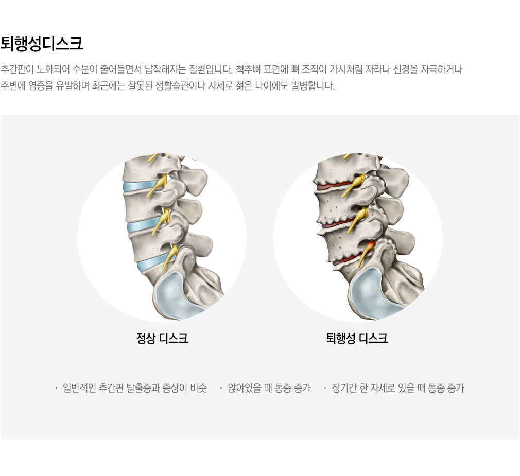 내시경 치료 가능한 척추질환
