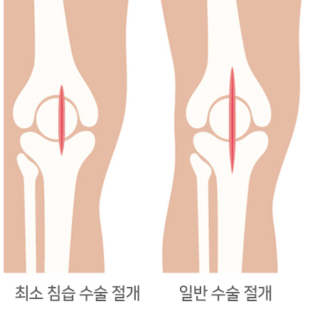 최소침습