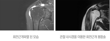회전근개파열 치료 이미지