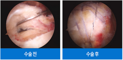 수술 차이점 이미지