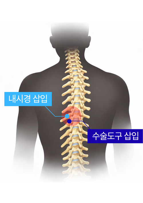 양방향 척추 내시경