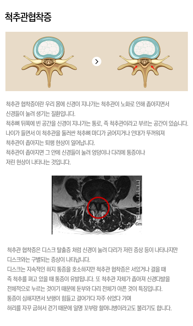 척추관협착증